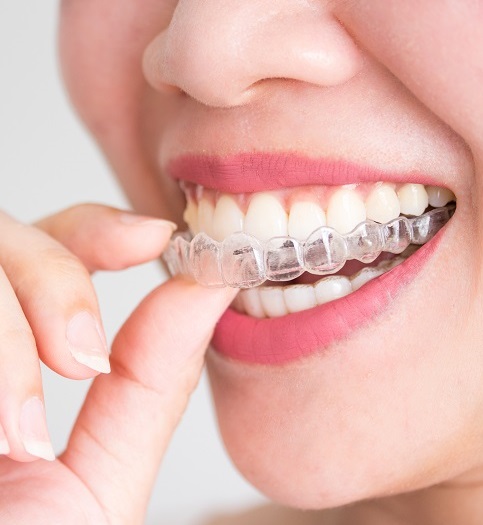 Nakładki ortodontyczne a aktywny tryb życia – co warto wiedzieć?