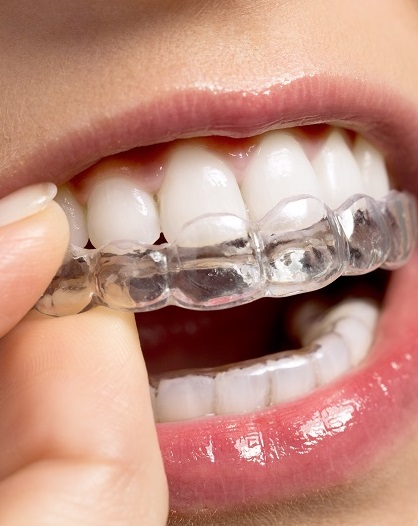 Dlaczego warto prostować zęby nawet w dorosłym wieku?