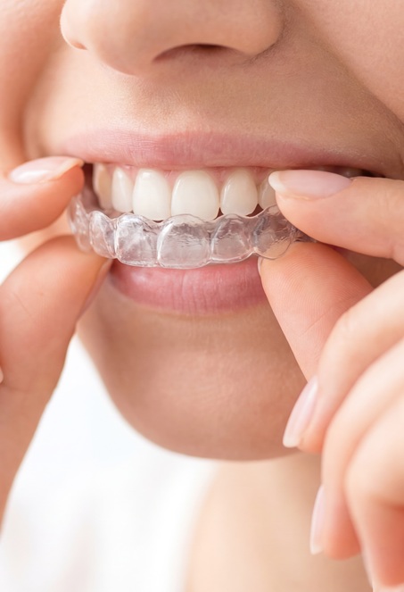 Proste zęby – tylko estetyka czy coś więcej?