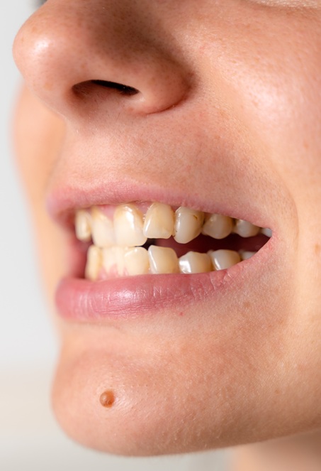 Czy warto prostować zęby, jeśli nie przeszkadzają?