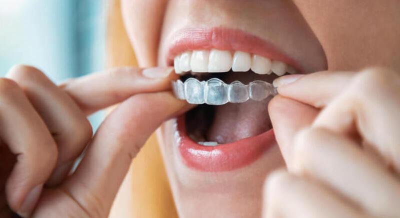 Czym jest Invisalign i ile kosztuje?