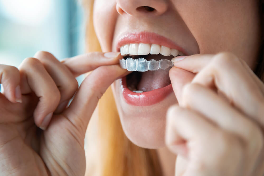 Czym jest Invisalign i ile kosztuje?